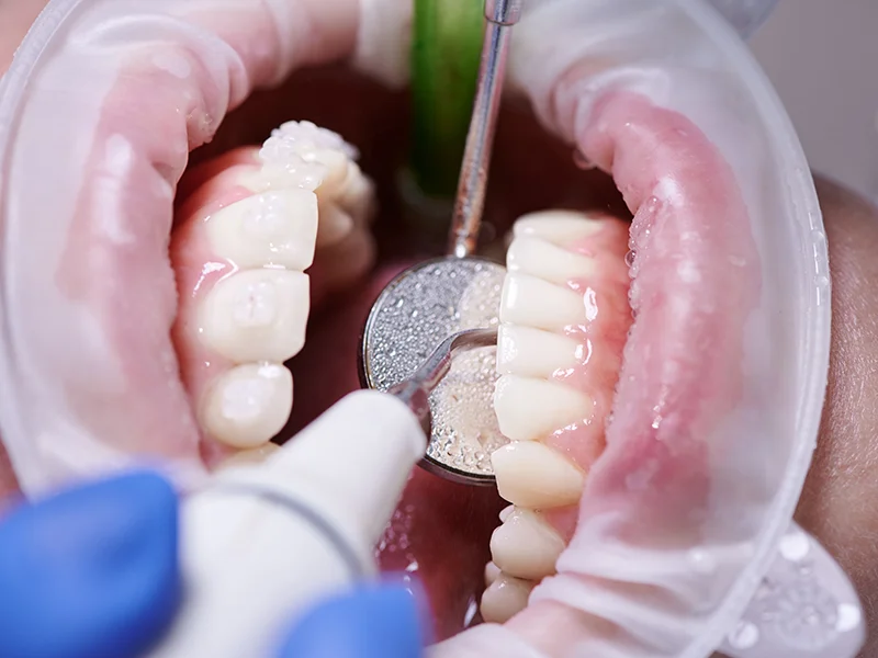 limpieza dental tratamientos